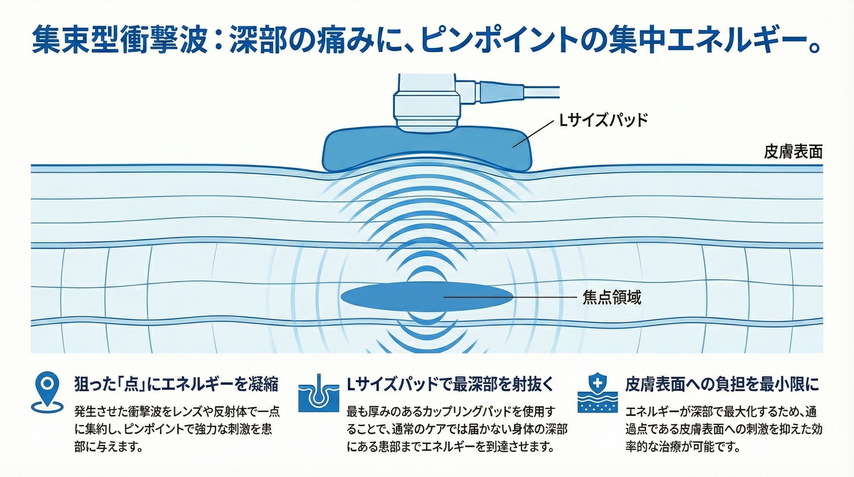 集束型衝撃波治療は深部の患部へピンポイントで作用します